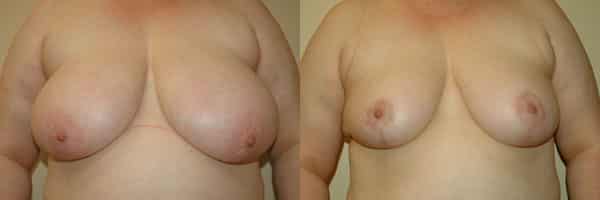 Breast Reduction before and after photo by Dr. Richard A. Bartlett in Brookline, MA
