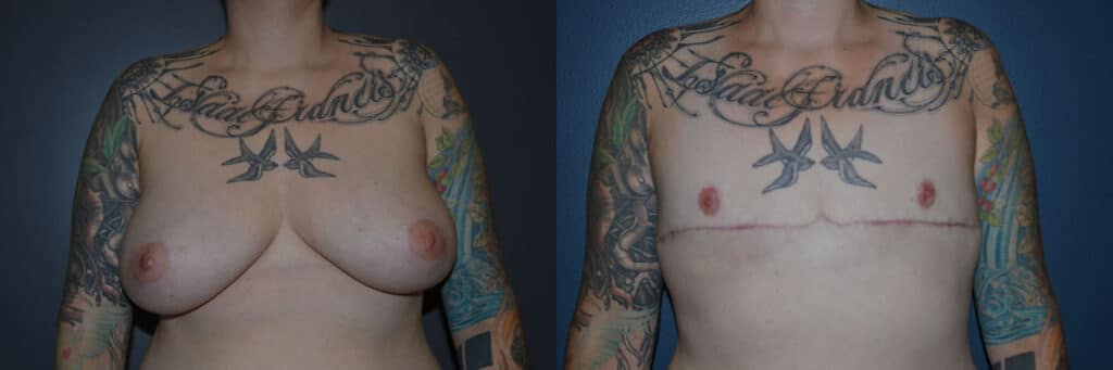 Gender Affirming Surgery before and after photo by Dr. Richard A. Bartlett in Brookline, MA