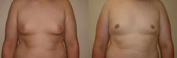 Gynecomastia (Male Breast Reduction) before and after photo by Dr. Richard A. Bartlett in Brookline, MA