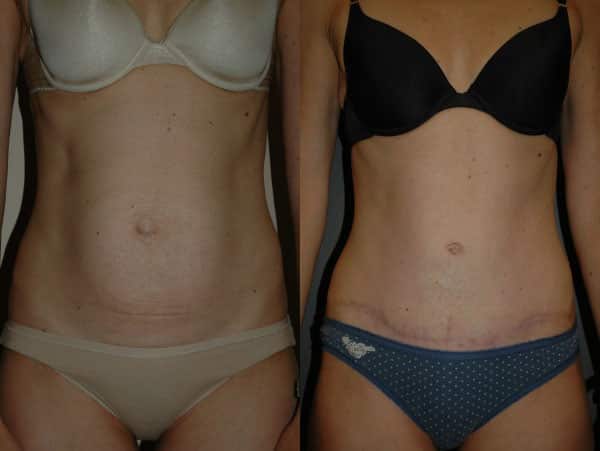 Abdominoplasty (Tummy Tuck) before and after photo by Dr. Richard A. Bartlett in Brookline, MA