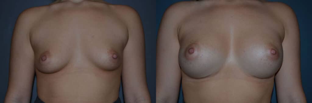Breast Augmentation before and after photo by Dr. Richard A. Bartlett in Brookline, MA