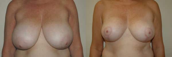 Breast Reduction before and after photo by Dr. Richard A. Bartlett in Brookline, MA