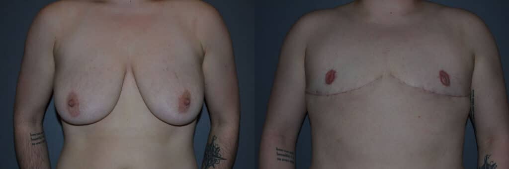 Gender Affirming Surgery before and after photo by Dr. Richard A. Bartlett in Brookline, MA