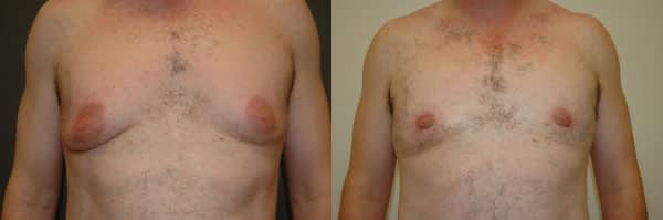 Gynecomastia (Male Breast Reduction) before and after photo by Dr. Richard A. Bartlett in Brookline, MA