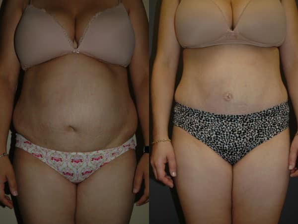 Abdominoplasty (Tummy Tuck) before and after photo by Dr. Richard A. Bartlett in Brookline, MA
