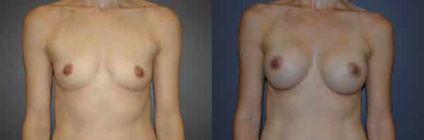 Breast Augmentation before and after photo by Dr. Richard A. Bartlett in Brookline, MA