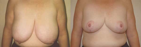 Breast Reduction before and after photo by Dr. Richard A. Bartlett in Brookline, MA