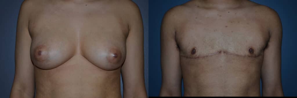Gender Affirming Surgery before and after photo by Dr. Richard A. Bartlett in Brookline, MA