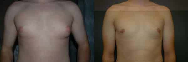 Gynecomastia (Male Breast Reduction) before and after photo by Dr. Richard A. Bartlett in Brookline, MA