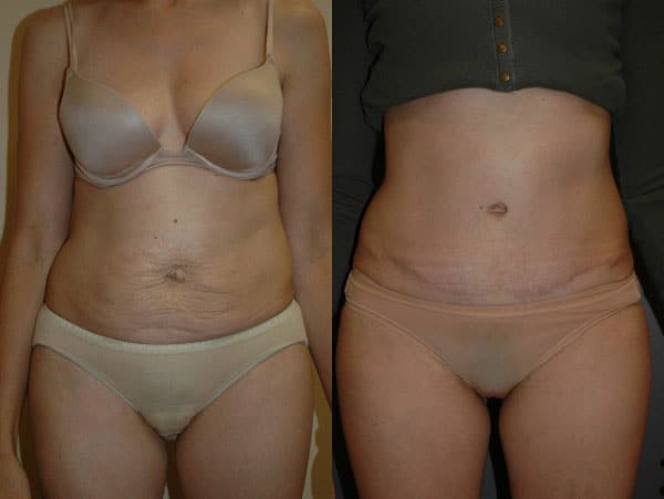 Abdominoplasty (Tummy Tuck) before and after photo by Dr. Richard A. Bartlett in Brookline, MA