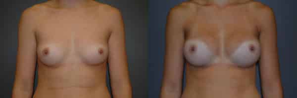 Breast Augmentation before and after photo by Dr. Richard A. Bartlett in Brookline, MA