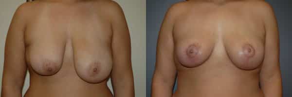 Breast Lift before and after photo by Dr. Richard A. Bartlett in Brookline, MA