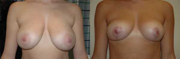 Breast Reduction before and after photo by Dr. Richard A. Bartlett in Brookline, MA