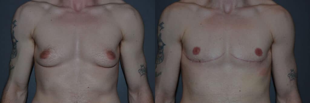Gender Affirming Surgery before and after photo by Dr. Richard A. Bartlett in Brookline, MA