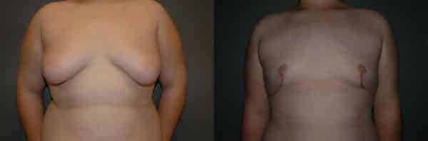 Gynecomastia (Male Breast Reduction) before and after photo by Dr. Richard A. Bartlett in Brookline, MA