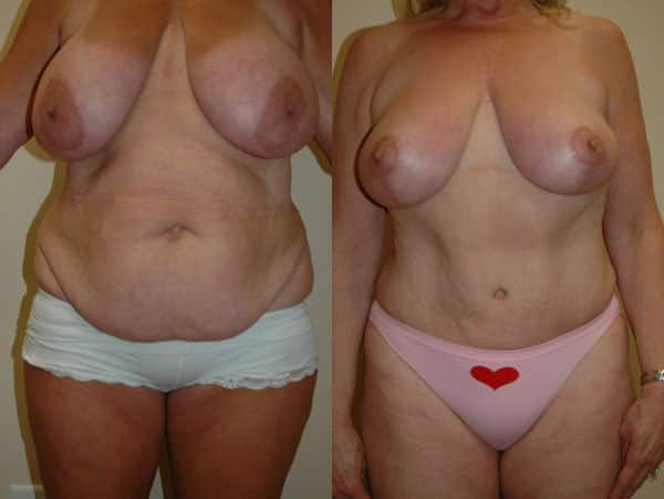 Abdominoplasty (Tummy Tuck) before and after photo by Dr. Richard A. Bartlett in Brookline, MA
