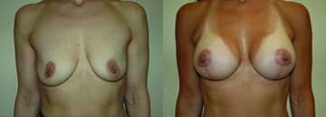 Breast Augmentation before and after photo by Dr. Richard A. Bartlett in Brookline, MA