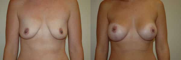 Breast Lift before and after photo by Dr. Richard A. Bartlett in Brookline, MA