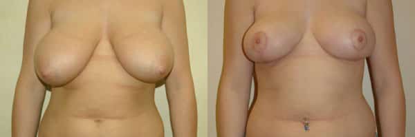 Breast Reduction before and after photo by Dr. Richard A. Bartlett in Brookline, MA