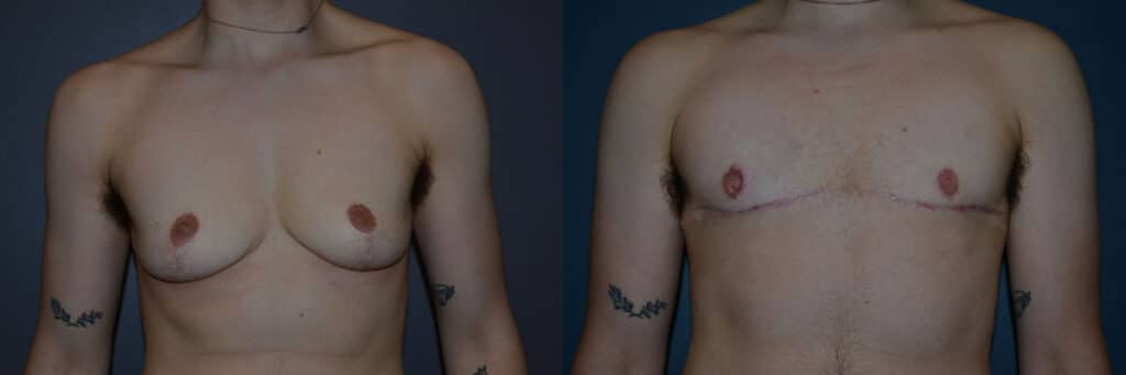 Gender Affirming Surgery before and after photo by Dr. Richard A. Bartlett in Brookline, MA