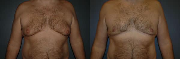 Gynecomastia (Male Breast Reduction) before and after photo by Dr. Richard A. Bartlett in Brookline, MA