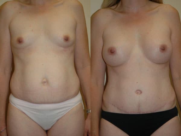 Abdominoplasty (Tummy Tuck) before and after photo by Dr. Richard A. Bartlett in Brookline, MA