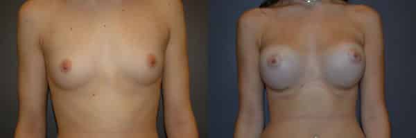 Breast Augmentation before and after photo by Dr. Richard A. Bartlett in Brookline, MA