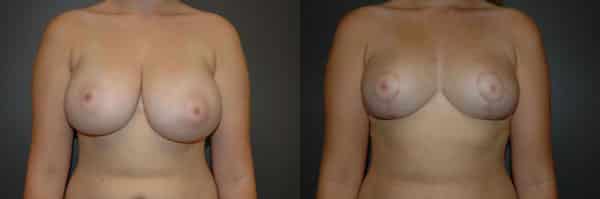 Breast Reduction before and after photo by Dr. Richard A. Bartlett in Brookline, MA