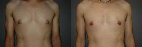 Gynecomastia (Male Breast Reduction) before and after photo by Dr. Richard A. Bartlett in Brookline, MA