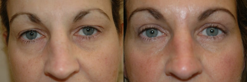 Blepharoplasty (Eyelid Surgery) before and after photo by Dr. Richard A. Bartlett in Brookline, MA