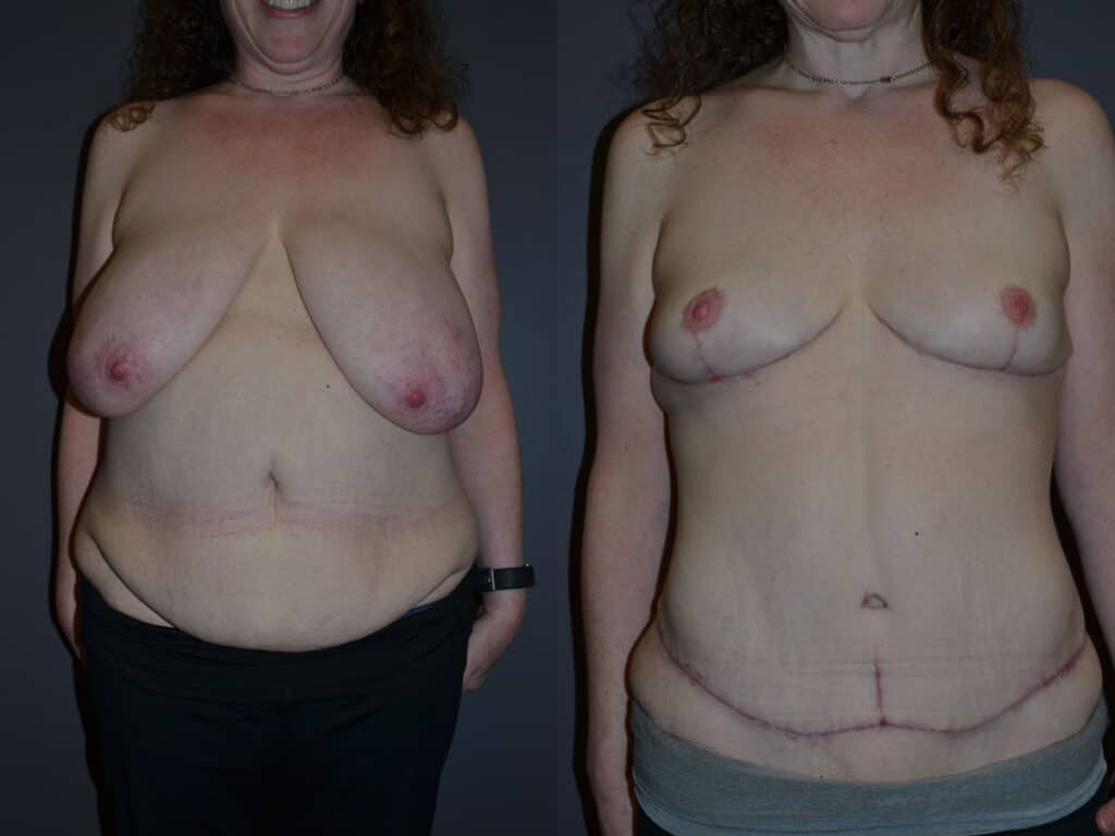 Abdominoplasty (Tummy Tuck) before and after photo by Dr. Richard A. Bartlett in Brookline, MA