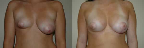 Breast Asymmetry before and after photo by Dr. Richard A. Bartlett in Brookline, MA