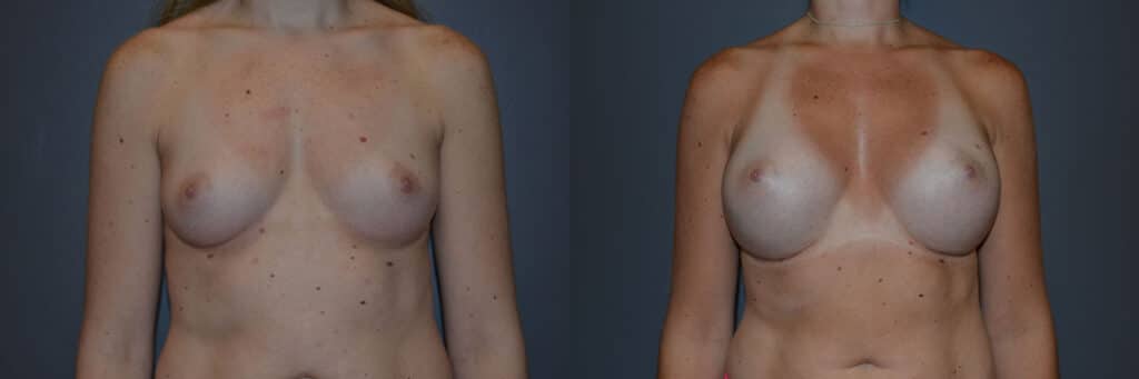 Breast Augmentation before and after photo by Dr. Richard A. Bartlett in Brookline, MA