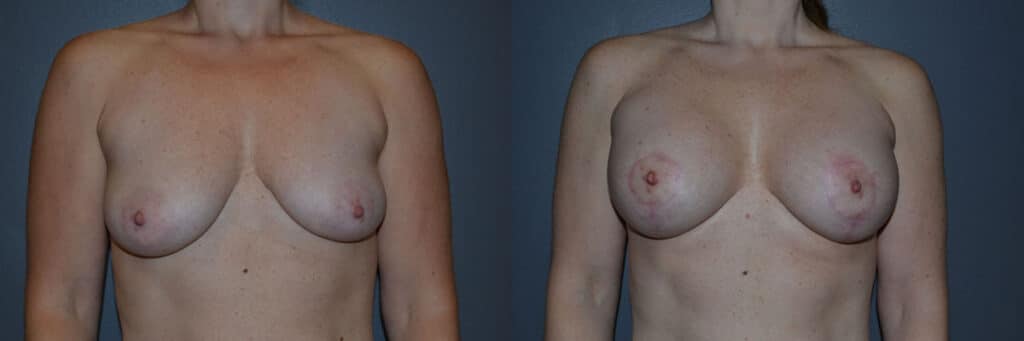 Breast Lift before and after photo by Dr. Richard A. Bartlett in Brookline, MA
