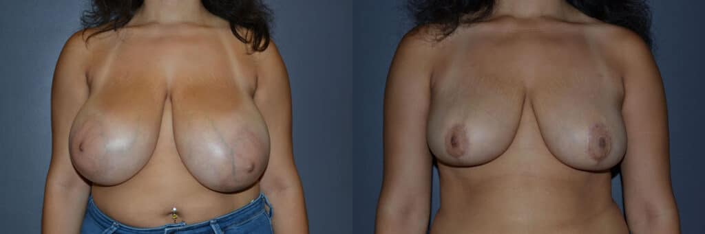 Breast Reduction before and after photo by Dr. Richard A. Bartlett in Brookline, MA