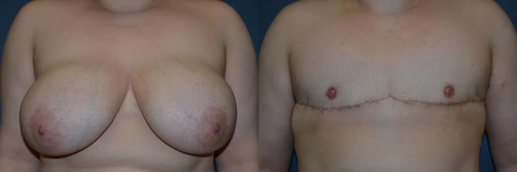 Gender Affirming Surgery before and after photo by Dr. Richard A. Bartlett in Brookline, MA