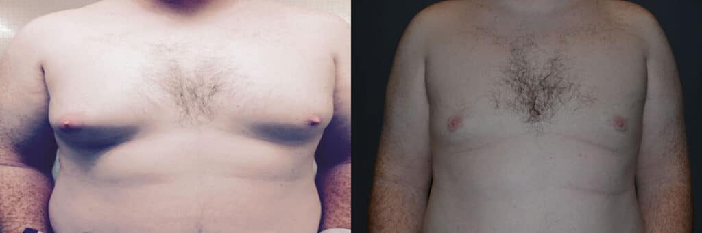 Gynecomastia (Male Breast Reduction) before and after photo by Dr. Richard A. Bartlett in Brookline, MA