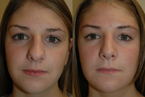 Rhinoplasty (Nose Surgery) before and after photo by Dr. Richard A. Bartlett in Brookline, MA