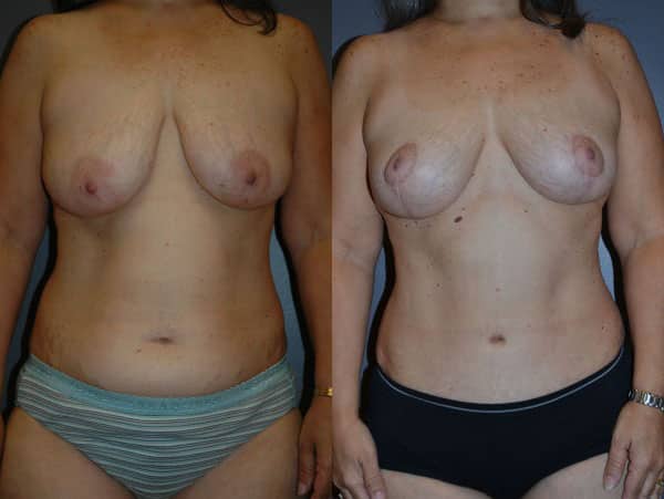 Abdominoplasty (Tummy Tuck) before and after photo by Dr. Richard A. Bartlett in Brookline, MA