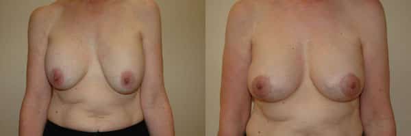 Breast Augmentation before and after photo by Dr. Richard A. Bartlett in Brookline, MA