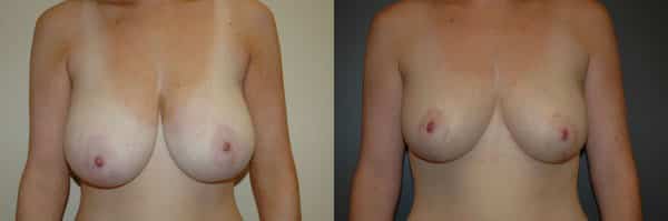 Breast Reduction before and after photo by Dr. Richard A. Bartlett in Brookline, MA