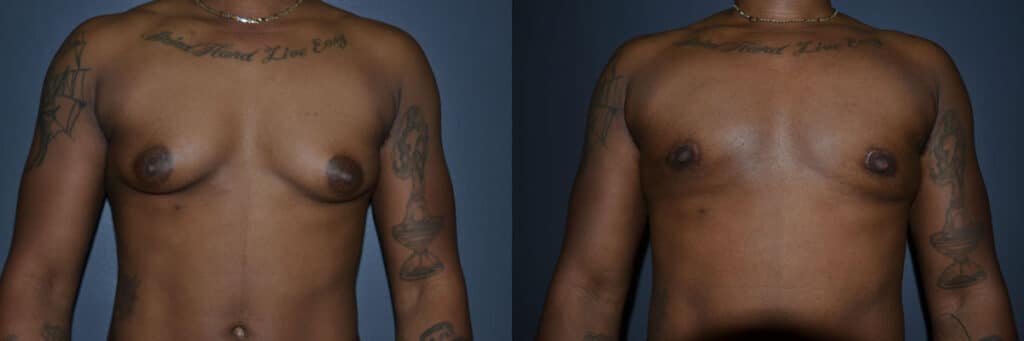 Gender Affirming Surgery before and after photo by Dr. Richard A. Bartlett in Brookline, MA