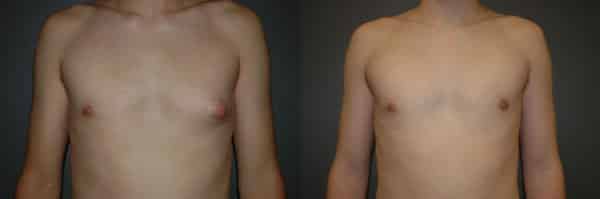 Gynecomastia (Male Breast Reduction) before and after photo by Dr. Richard A. Bartlett in Brookline, MA