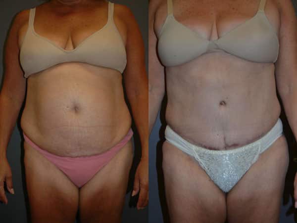 Abdominoplasty (Tummy Tuck) before and after photo by Dr. Richard A. Bartlett in Brookline, MA
