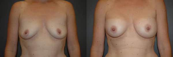 Breast Augmentation before and after photo by Dr. Richard A. Bartlett in Brookline, MA