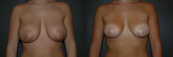 Breast Reduction before and after photo by Dr. Richard A. Bartlett in Brookline, MA