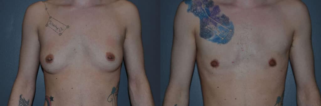 Gender Affirming Surgery before and after photo by Dr. Richard A. Bartlett in Brookline, MA
