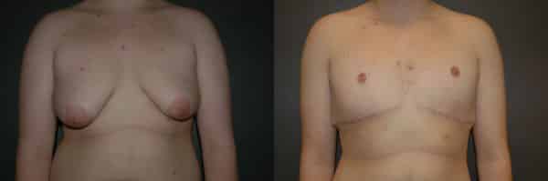 Gynecomastia (Male Breast Reduction) before and after photo by Dr. Richard A. Bartlett in Brookline, MA