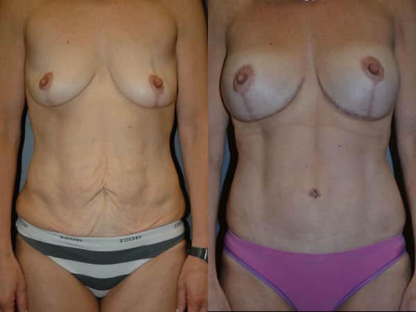 Abdominoplasty (Tummy Tuck) before and after photo by Dr. Richard A. Bartlett in Brookline, MA