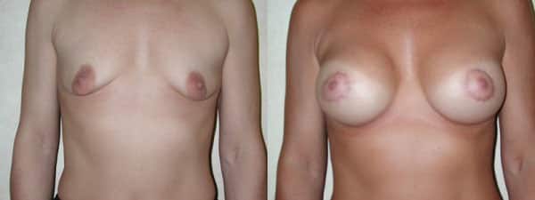 Breast Augmentation before and after photo by Dr. Richard A. Bartlett in Brookline, MA